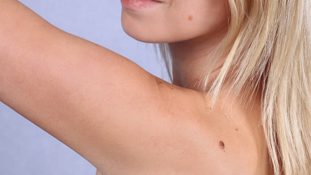 Jak se chránit před rakovinou kůže? Důležité je vyšetření a kontrola znamének FotoFinder