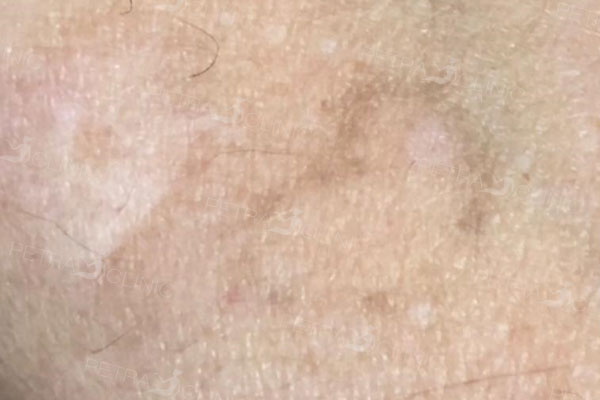 The result of tattoo removal after 1 treatment