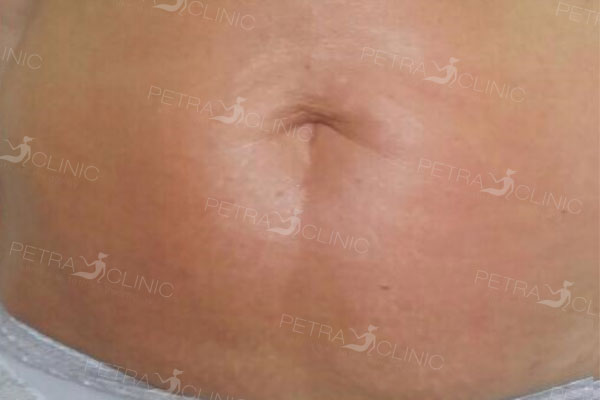 The result of non-invasive belly liposuction after 8 treatments
