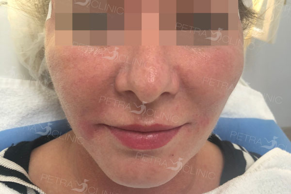 Skin tightening in the cheeks area by Thread lifting
