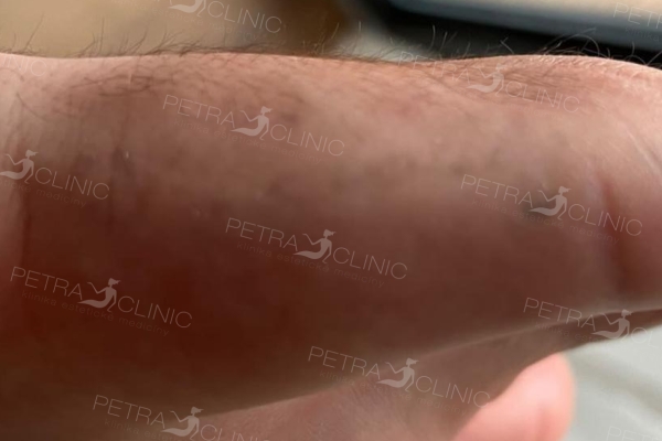 Odstranění tetování Picoplus laserem
